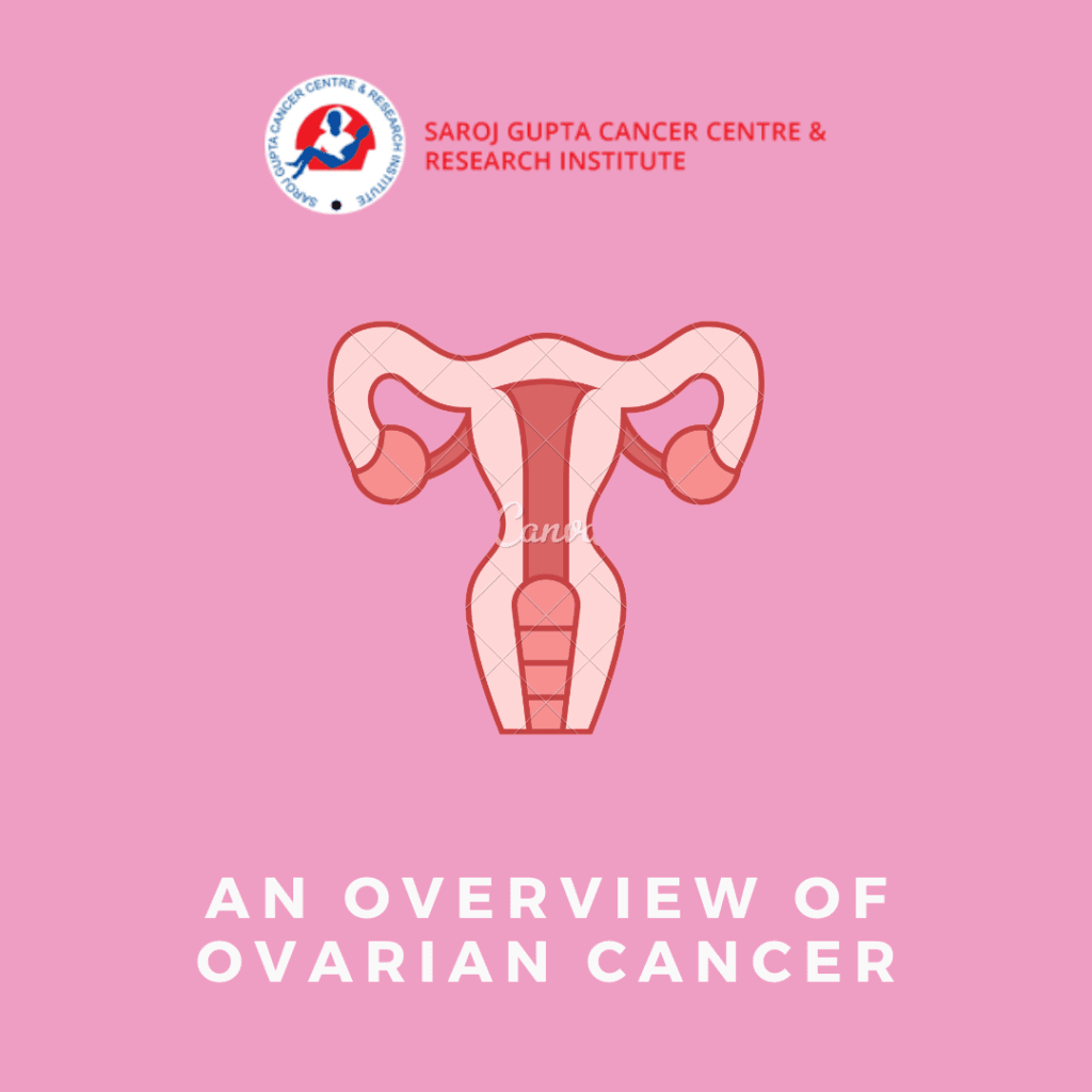ovarian cancer treatment