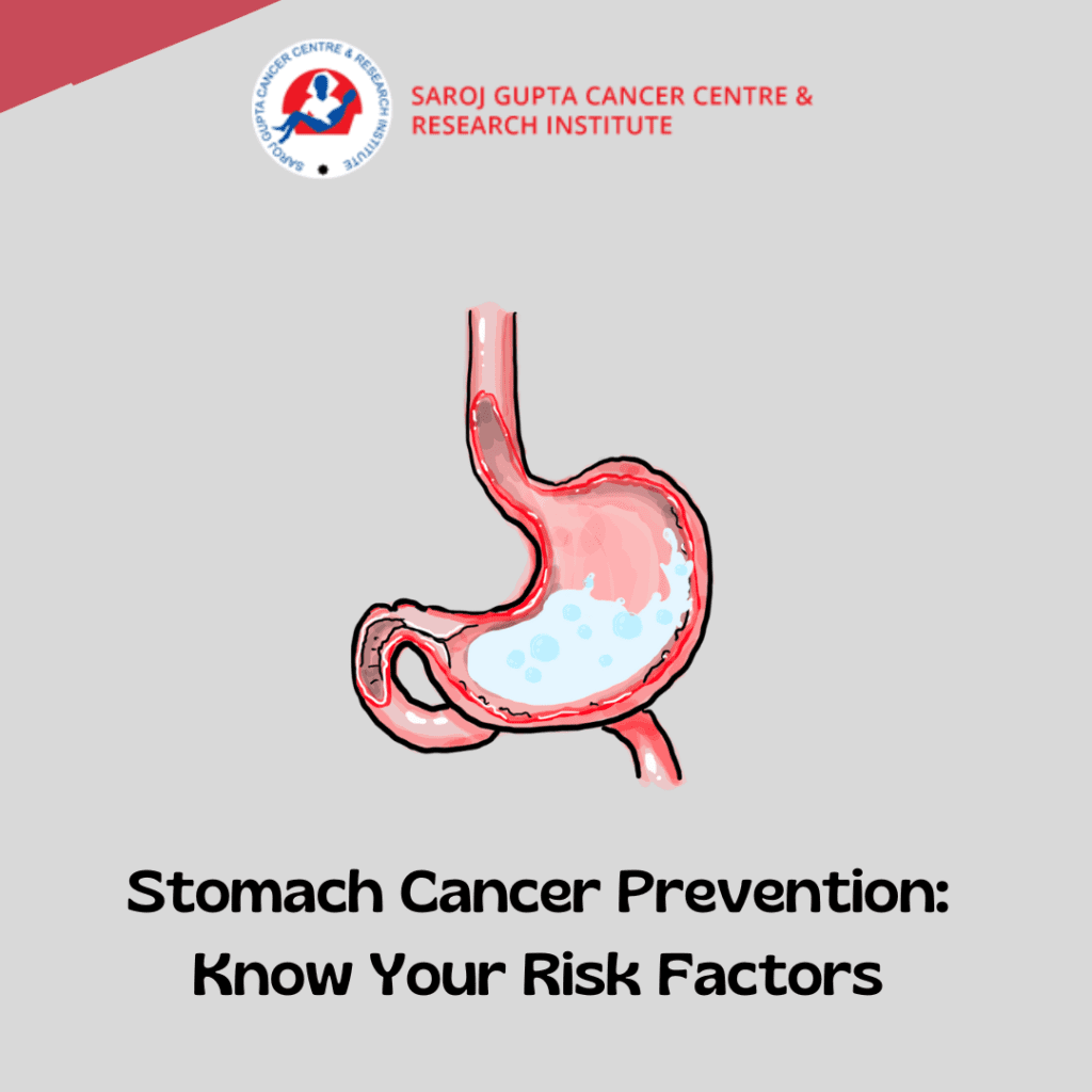 stomach-cancer-prevention-know-your-risk-factors